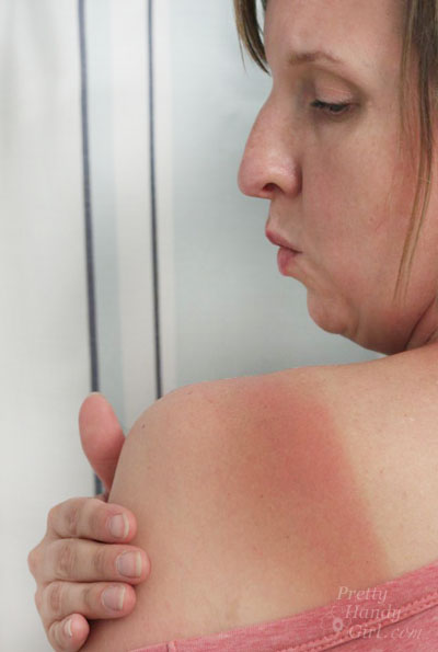 sunburned shoulder | Pretty Handy Girl